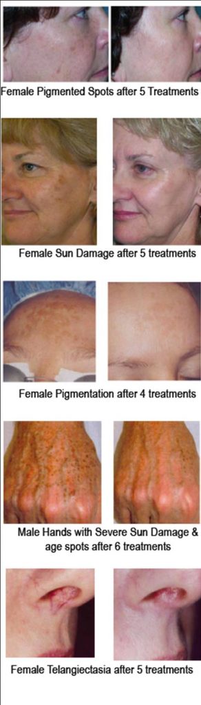 IPL Skin Rejuvenation - BodySense Solutions